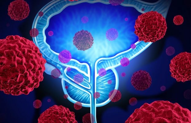 Cáncer de Próstata y la importancia de la detección oportuna